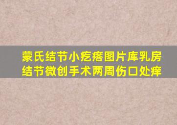 蒙氏结节小疙瘩图片库乳房结节微创手术两周伤口处痒